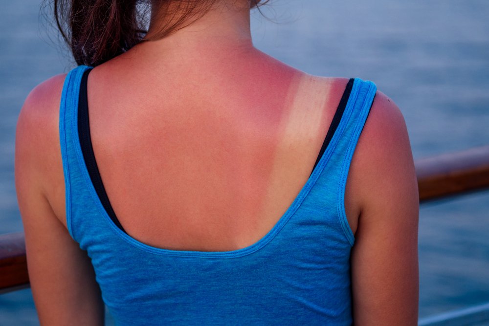 9 Best Essential Oils For Sunburn: Soothe, Cool, and Care for Your Skin