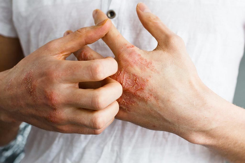 essential oil recipe for eczema