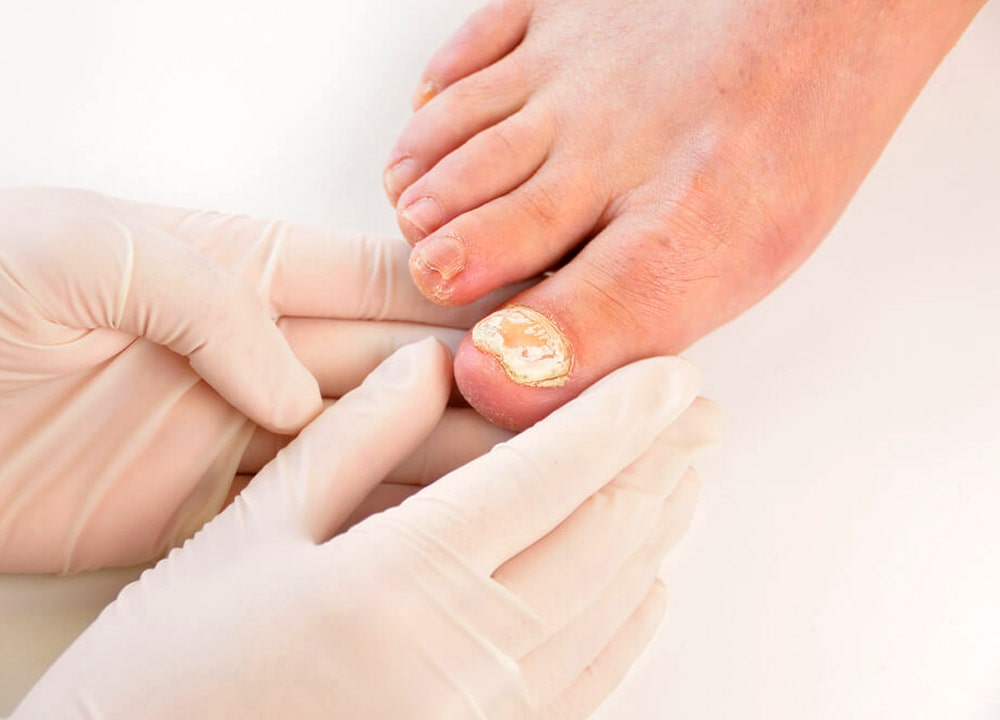 best essential oils for toenail fungus